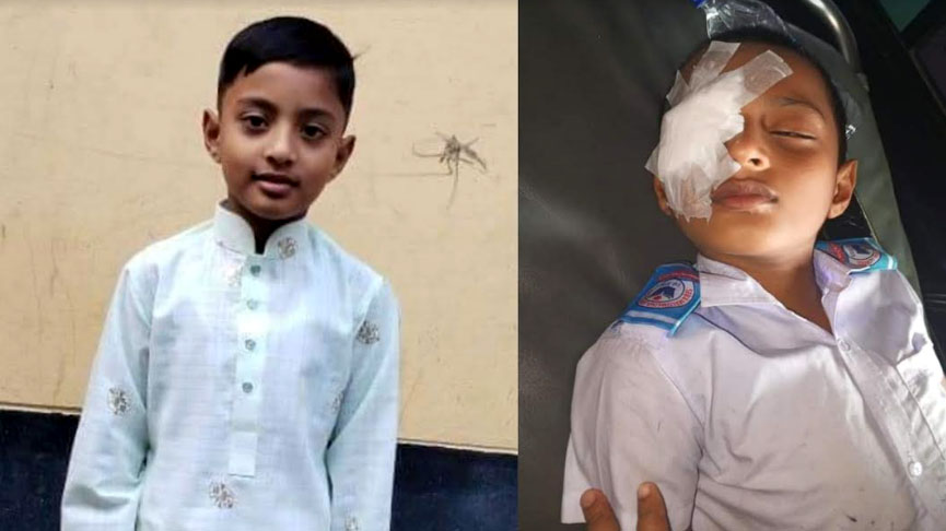 তিতাসে শিক্ষকের বেত্রাঘাতে চোখ হারালো শিক্ষার্থী 
