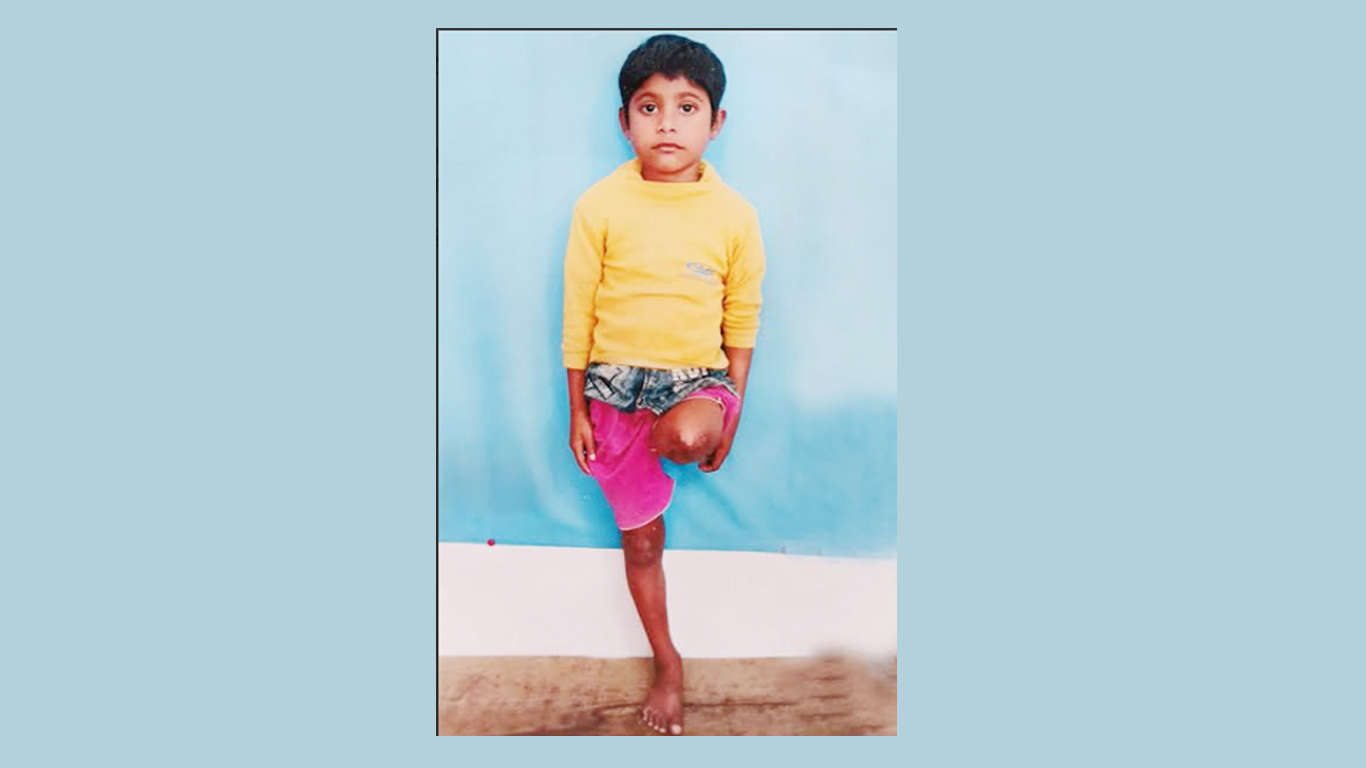 দুর্ঘটনায় পা হারানো শিশু মোবাস্বিরের চিকিৎসার এগিয়ে আসুন